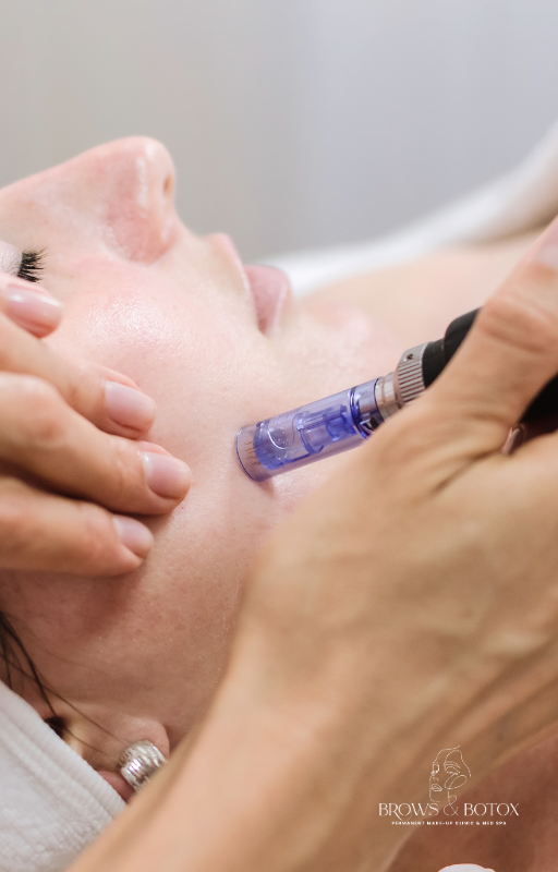 Microneedling treatment at Brows & Botox Med Spa